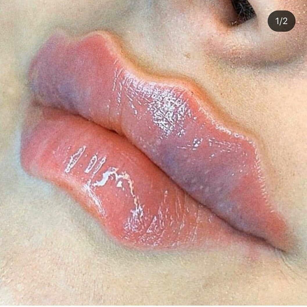 Губы-осьминоги: сумасшедший тренд покоряет Instagram - фото 459765
