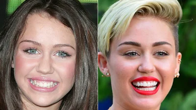  Звездная улыбка: до и после
