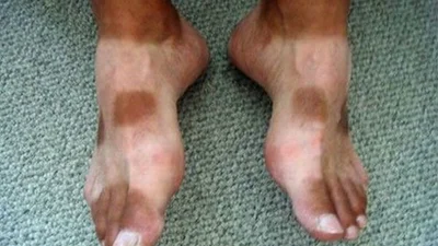 Усе пішло не так: як не треба засмагати влітку