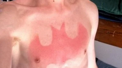 Шалене літо: люди показують, як не потрібно засмагати