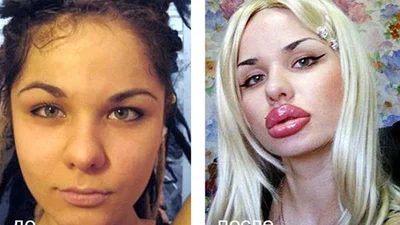 Страх и ужас: девушки до и после увеличения губ