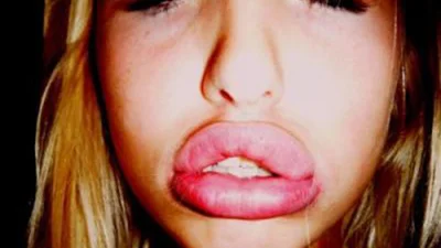 Як силікон може перетворити ваше обличчя на казна-що