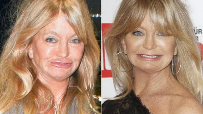 Зірки, які серйозно облажались з пластикою губ