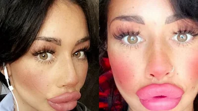 Неймовірна пластика: британка збільшила губи і не хоче зупинятися