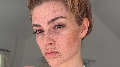 Дівчина з ластовинням стала новою зіркою Instagram
