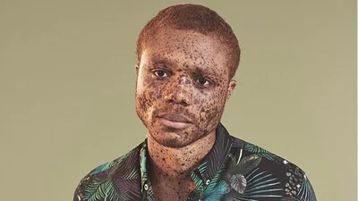 Темнокожий парень с веснушками стал самым очаровательным манекенщиком в мире