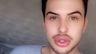 Парень увлекся увеличением губ и превратился в посмешище