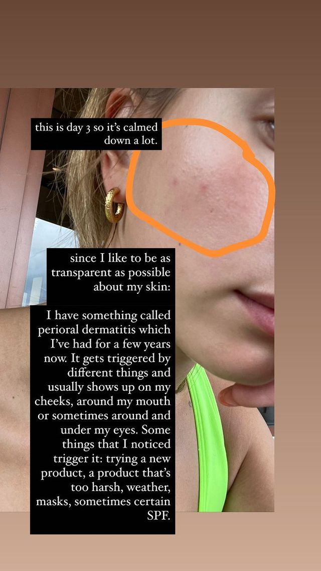 Гейлі Бібер показала свою шкіру без макіяжу, і вона геть не бездоганна - фото 499604
