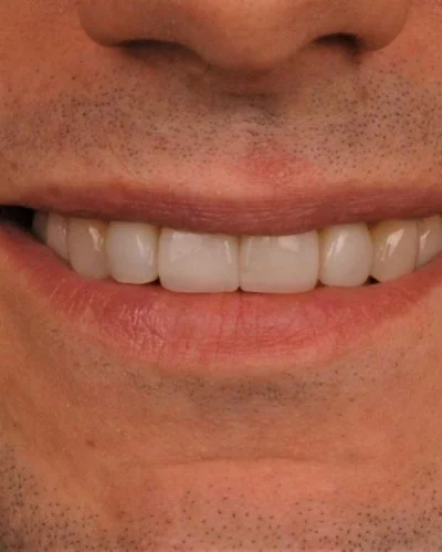 Олександр Еллерт зробив 'нові' зуби й похвалився результатом - фото 525226
