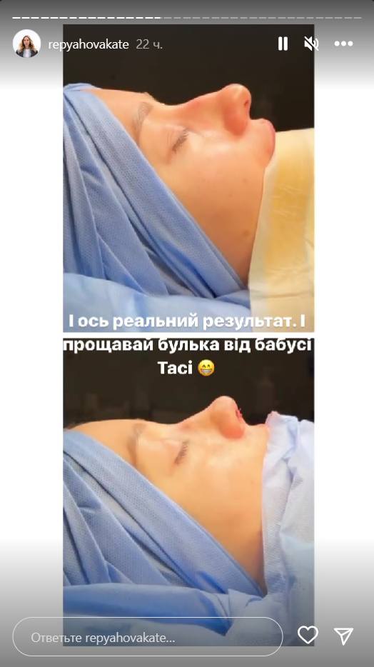 Катерина Репяхова відповіла, скільки заплатила за пластику носа - фото 555133