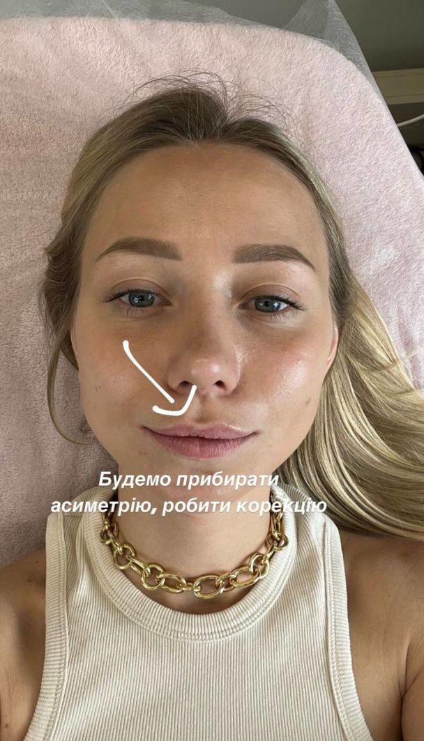 Катерина Репяхова показала, як збільшила губи: фото 'до' і 'після' ін'єкції - 561707 Катерина Репяхова показала, як збільшила губи: фото 'до' і 'після' ін'єкції - фото 561707