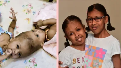 У Лондоні провели унікальну операцію сіамським близнючкам, які мали один череп – фото