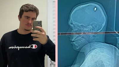 Чого тільки не буває: хлопець кілька днів проходив з кулею в голові, не підозрюючи цього