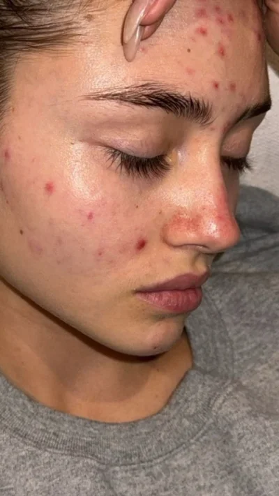 Дочь Хайди Клум показала неидеальную кожу лица с акне - фото 596493