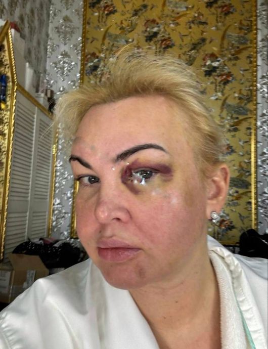 Камалия публично защитила мужа после появления ее странных фото с синяками на лице - фото 608414