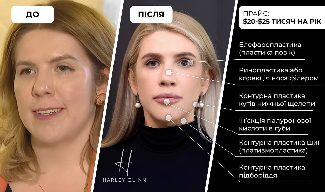 Кіра Рудик до і після пластики - 614630 Кіра Рудик до і після пластики - фото 614630