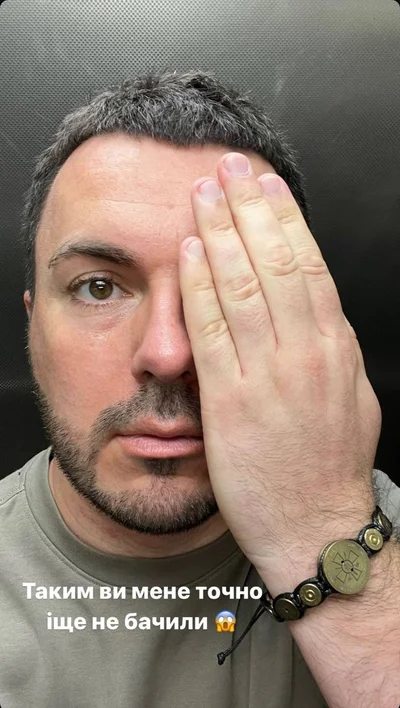 'Ні, не дружина', - Григорій Решетнік налякав розпухлим обличчям й розповів, що сталося - фото 623387