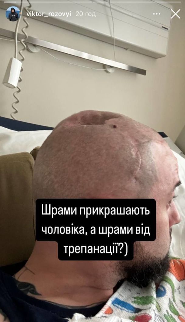 'Недобровільне СЗЧ': Виктор Розовый показал, как сейчас выглядят шрамы на голове - фото 664012