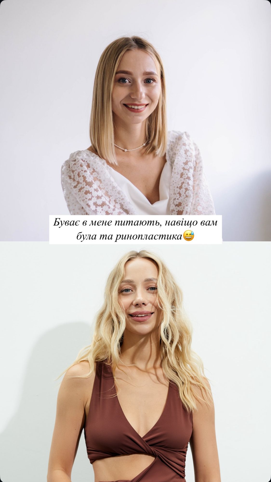 Катерина Репяхова показала себе до, під час і після ринопластики й заявила, що планує ще 2 нові операції - фото 677075