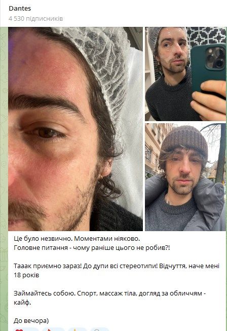 Дантес після процедури в косметолога - фото 677909