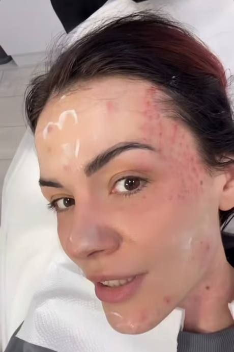 MamaRika уколола себе в лицо 'кое-что отвратительное' от лосося, чтобы омолодиться - фото 679987