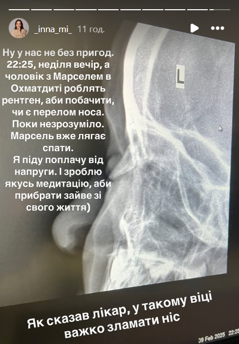 Марселю Мірошниченку зробили рентген  - фото 685824