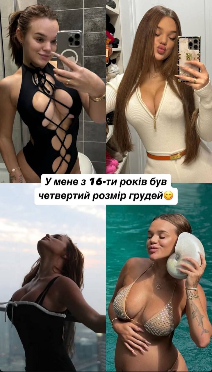 Верба сделала подтяжку груди и пережила самые болезненные дни жизни - смотри фото до и после операции - фото 725155
