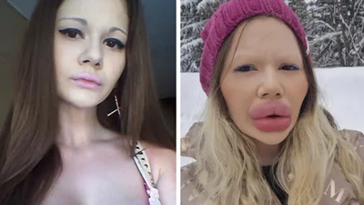 Трудно поверить, но вот как выглядела девушка с самыми большими губами в мире до операций