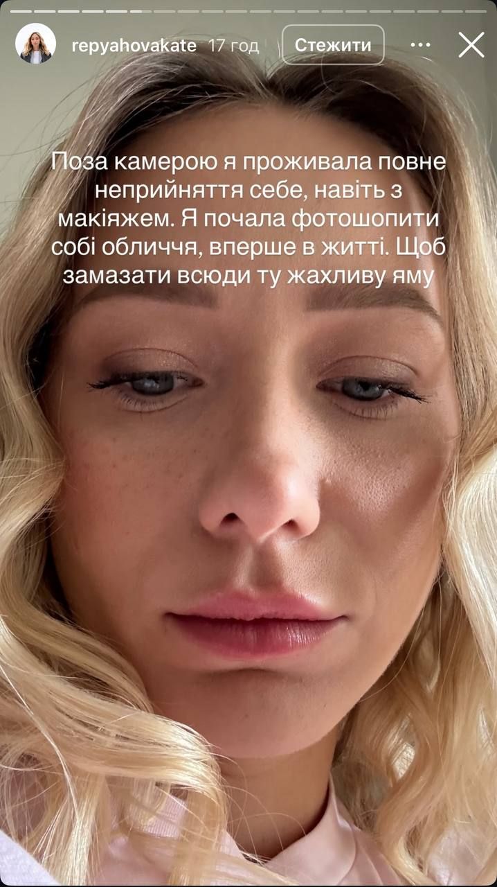 Дружина Віктора Павліка розповіла правду про невдалу пластику. - 774297 Дружина Віктора Павліка розповіла правду про невдалу пластику. - фото 774297