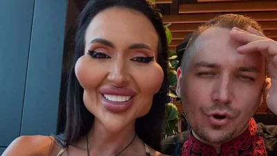 Где сейчас Анастасия Покрещук - как живет блогер с самыми большими скулами мира после всех изменений внешности