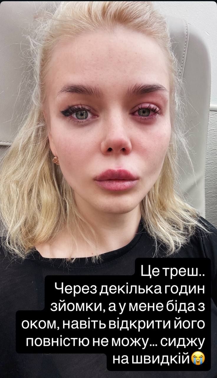 Аліна Гросу налякала шанувальників: співачка потрапила у швидку через травму ока - 783310 Аліна Гросу налякала шанувальників: співачка потрапила у швидку через травму ока - фото 783310