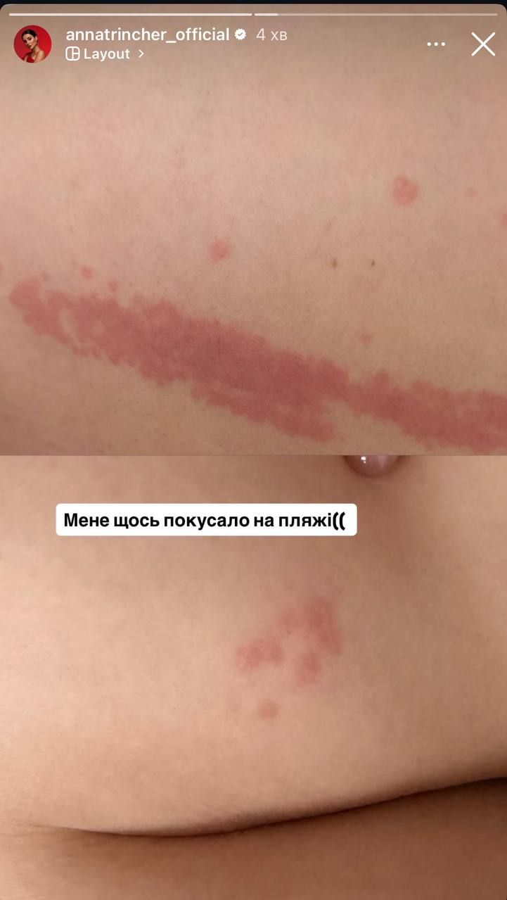 Анна Трінчер та укуси на відпочинку - 819000 Анна Трінчер та укуси на відпочинку - фото 819000
