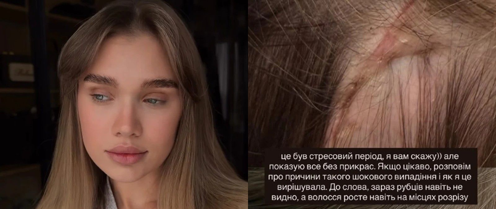 Після операції Саша почала втрачати частину волосся - фото 821067