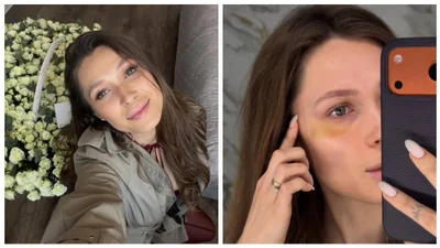 "Он меня бьет": Елена Светлицкая испугала фанатов огромным синяком под глазом