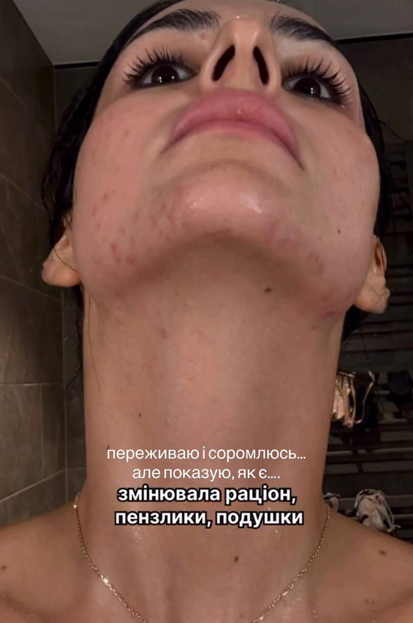 Ання Трінчер та її лікування акне - фото 840051