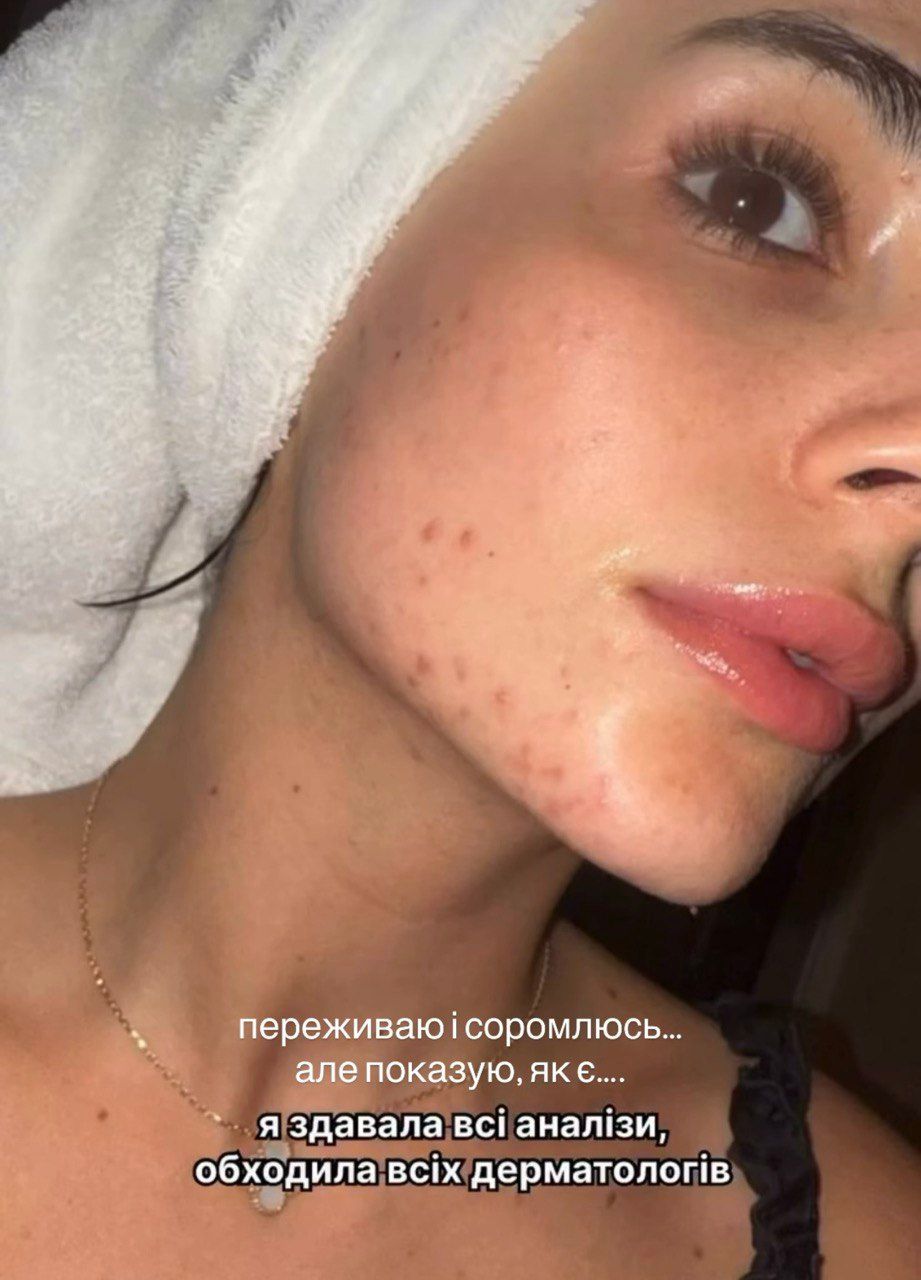 Анна Трінчер та прищі - фото 840053