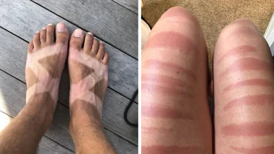 Эти люди точно пожалели, что вышли на солнце без защитного крема