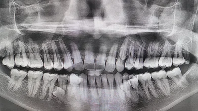 Цей чоловік має найбільшу кількість зубів у світі - на 10 більше, аніж зазвичай має людина