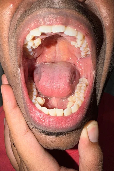 Цей чоловік має найбільшу кількість зубів у світі - на 10 більше, аніж зазвичай має людина - фото 847107