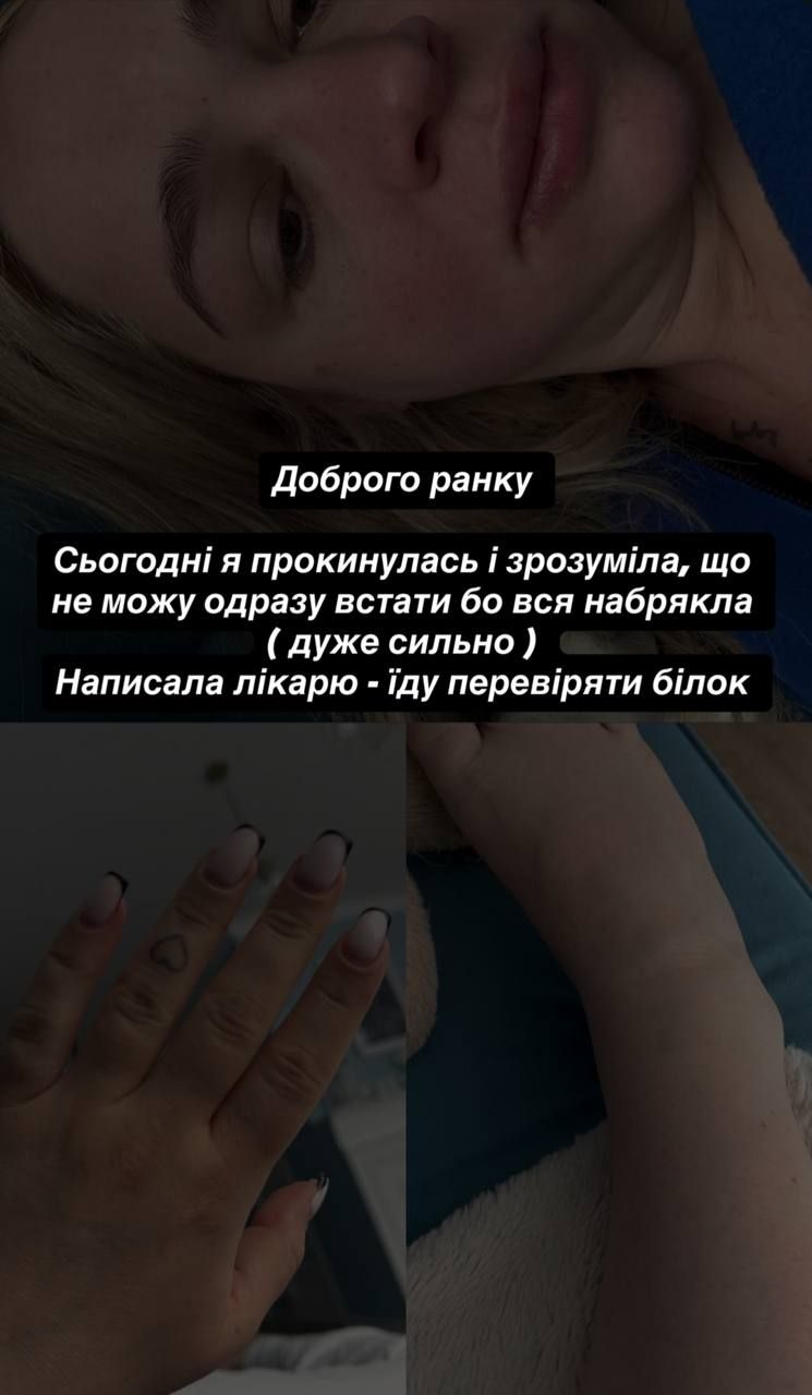 Інна Бєлєнь опухла - фото 852380