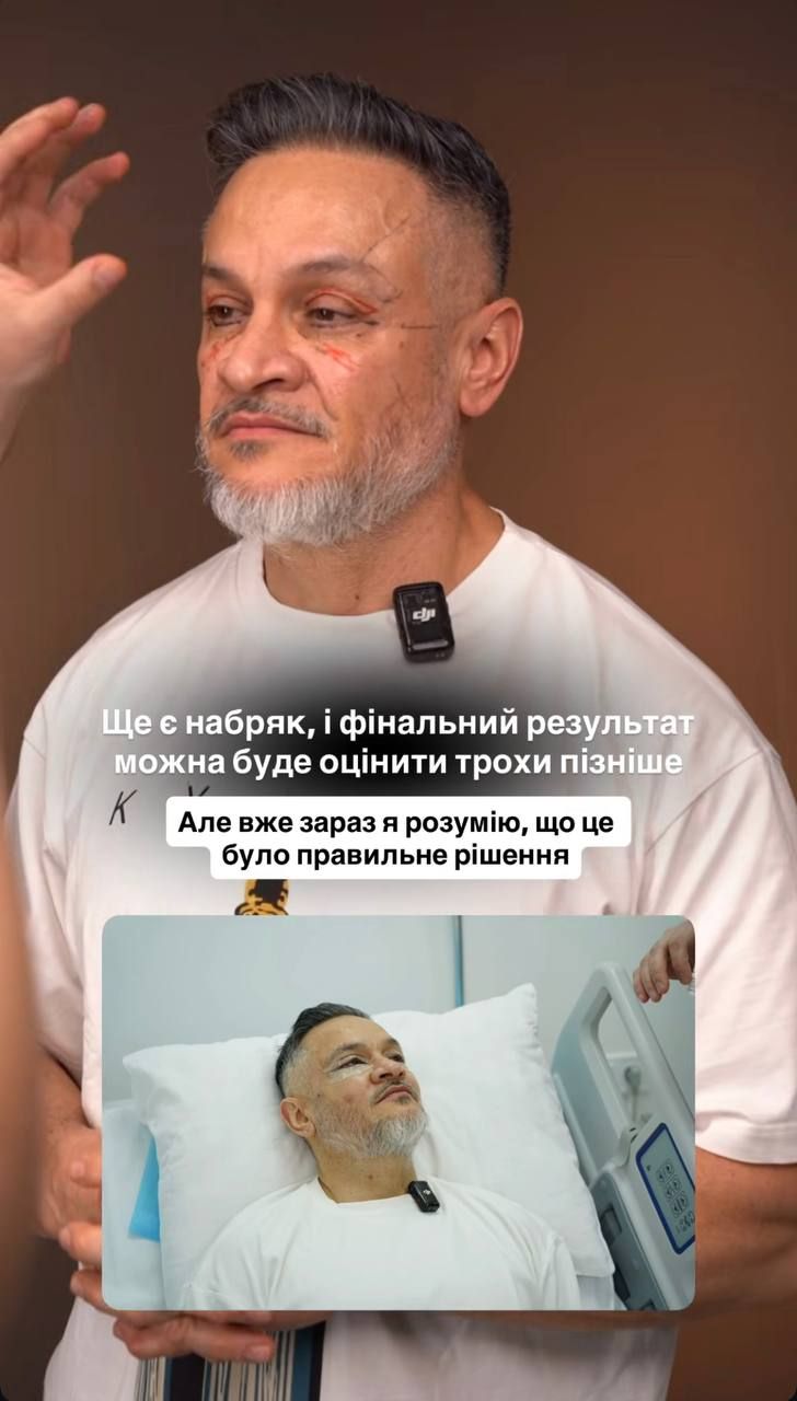 Ось такий вигляд має Ектор після блефаропластики - фото 853698