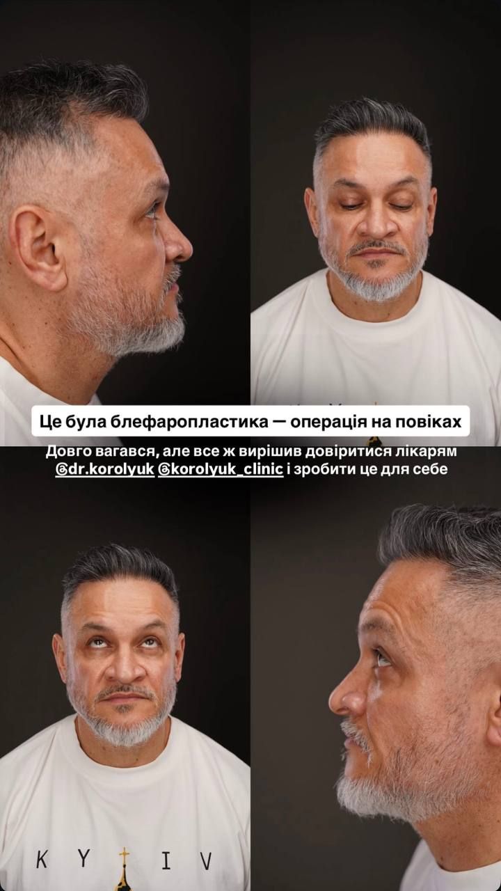 І вирішив чесно розповісти про пластичну операцію - фото 853699