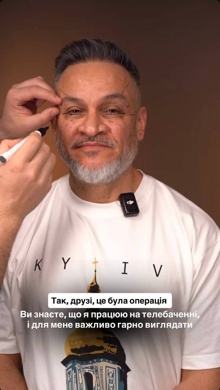Ектор Хіменес-Браво зробив підтяжку очей - фото 853700