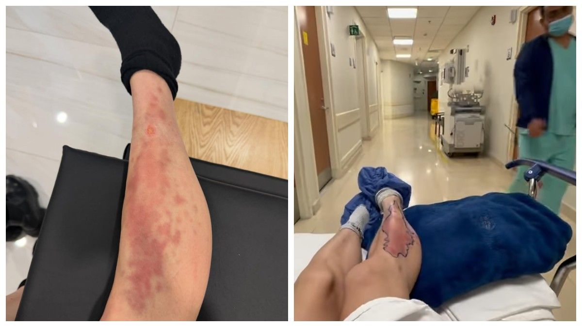 'Откусил от меня кусочек': звезда 'Сплетницы' загремела в больницу после нападения паука - 853995 'Откусил от меня кусочек': звезда 'Сплетницы' загремела в больницу после нападения паука - фото 853995