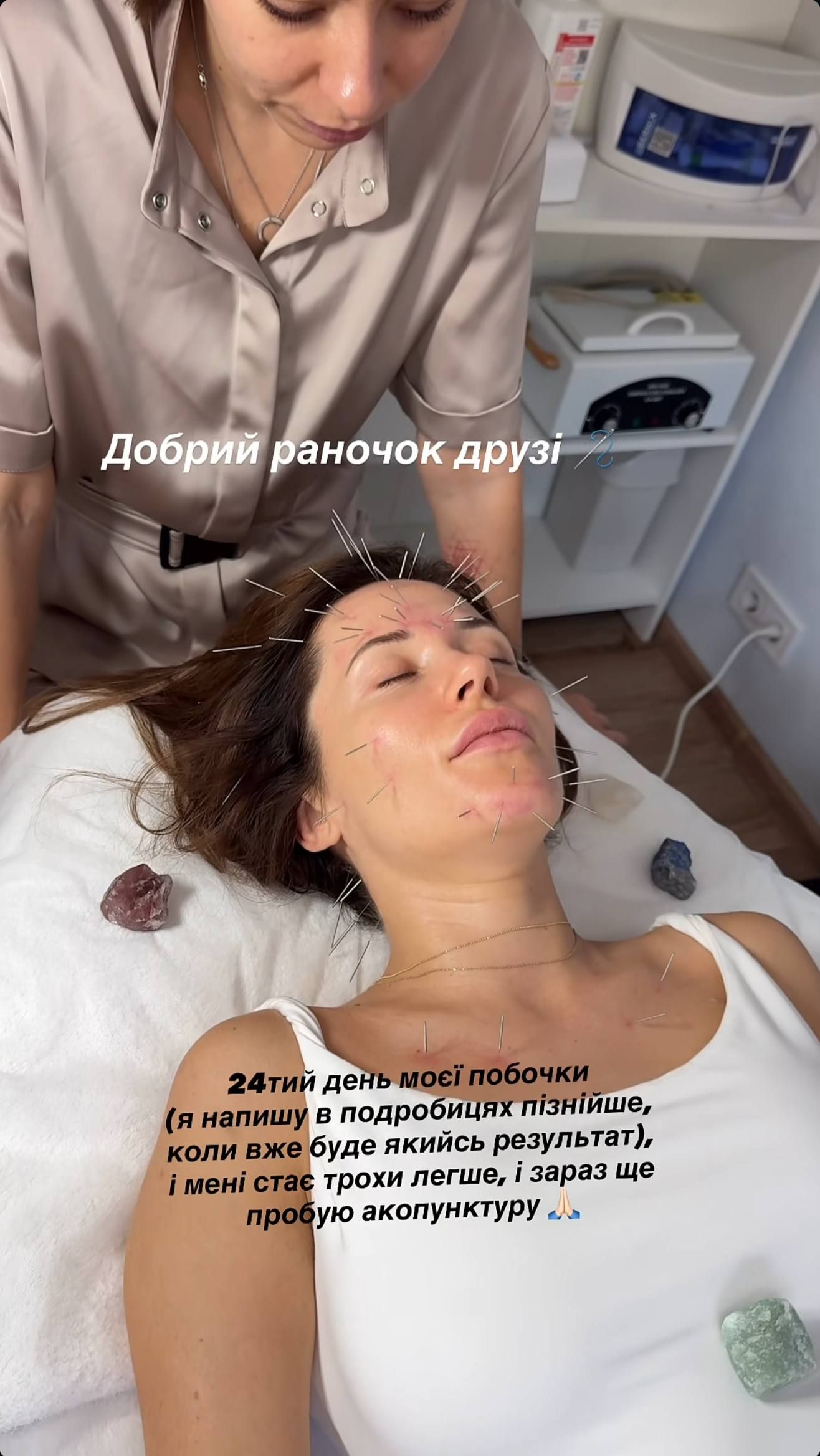 Наталка Денисенко на голкотерапії - 894678 Наталка Денисенко на голкотерапії - фото 894678