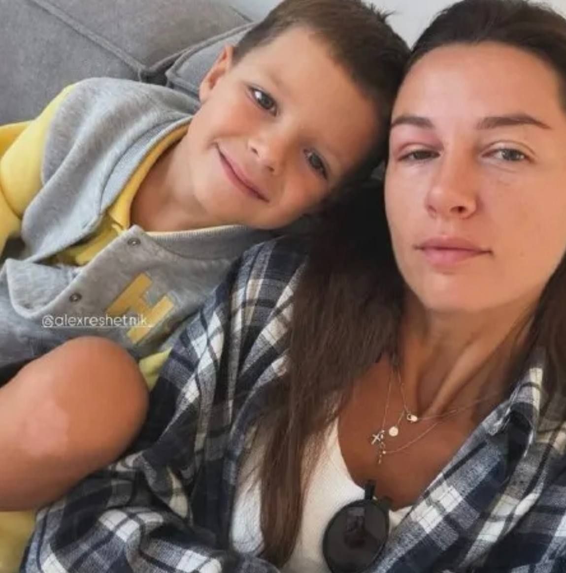Христина Решетнік та її око, яке сильно опухло - фото 911777