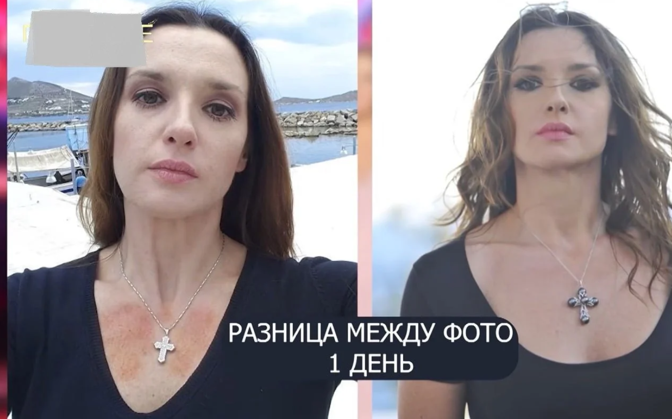 Оксана Марченко з опіками на тілі - фото. - фото 918461