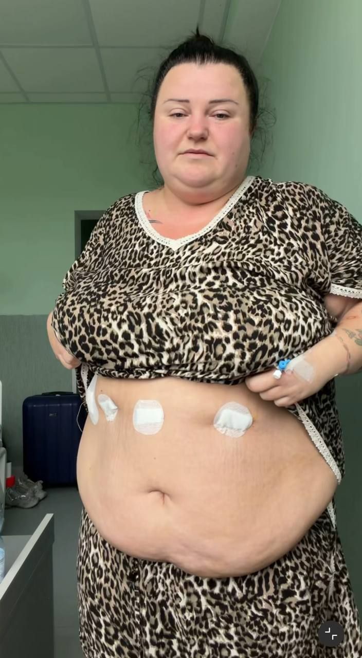 alyona alyona показала живіт після зменшення шлунка - 926570 alyona alyona показала живіт після зменшення шлунка - фото 926570